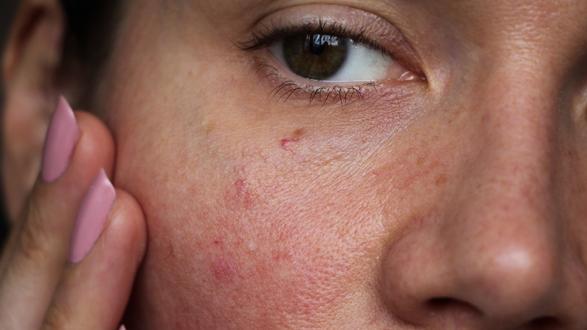 A closeup of a young girl's eye and cheek with pimples and redness; she has a hand with light pink nails on her face